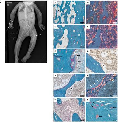 Investigating the role of ASCC1 in the causation of bone fragility